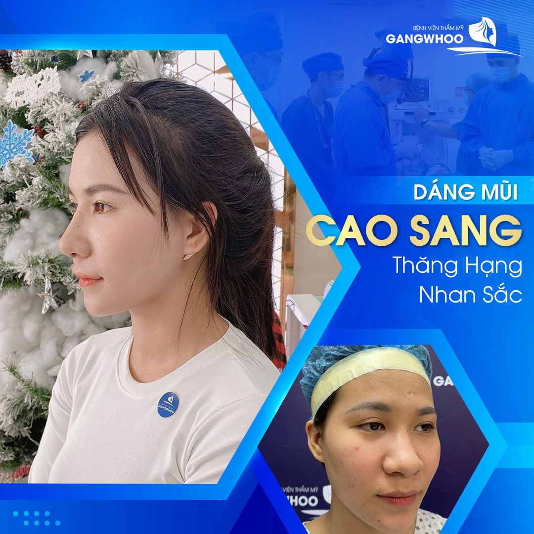 Dáng mũi cao sang và phù hợp với gương mặt