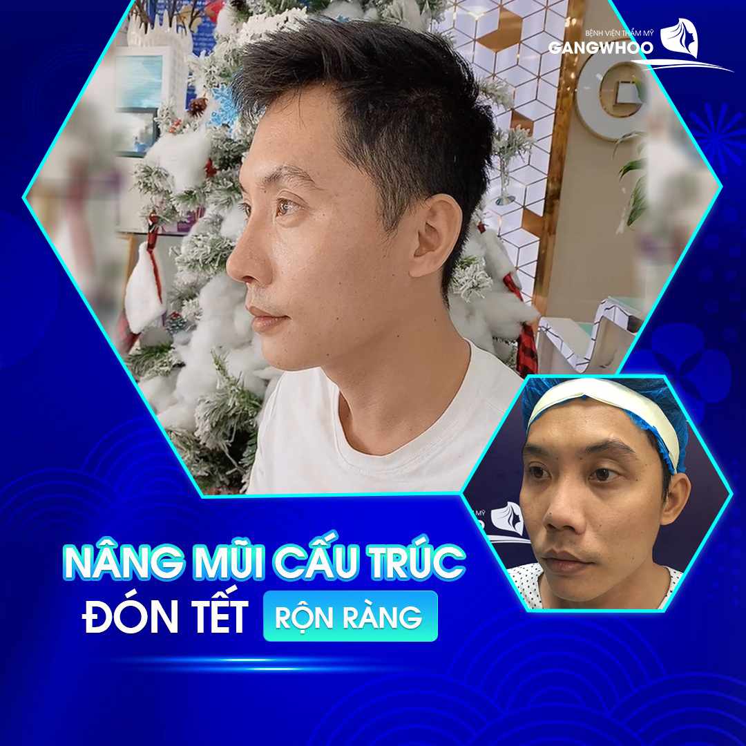 Nâng mũi cấu trúc giúp khắc phục các khuyết điểm của mũi