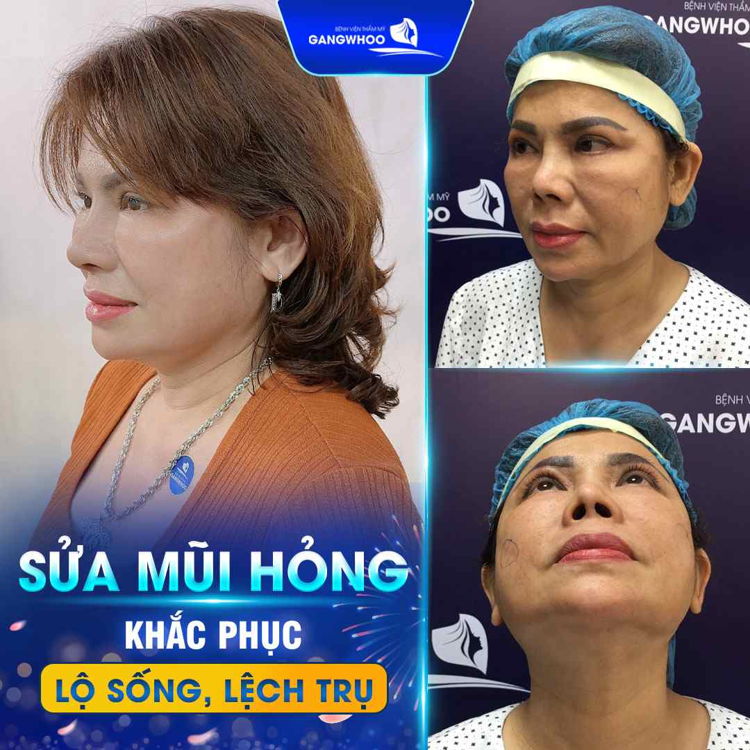 Nâng mũi sụn sườn khắc phục lại được dáng mũi đã hỏng