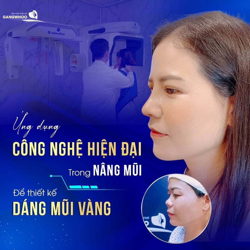 Nâng mũi S Line chuẩn hiện đại tại Gangwhoo
