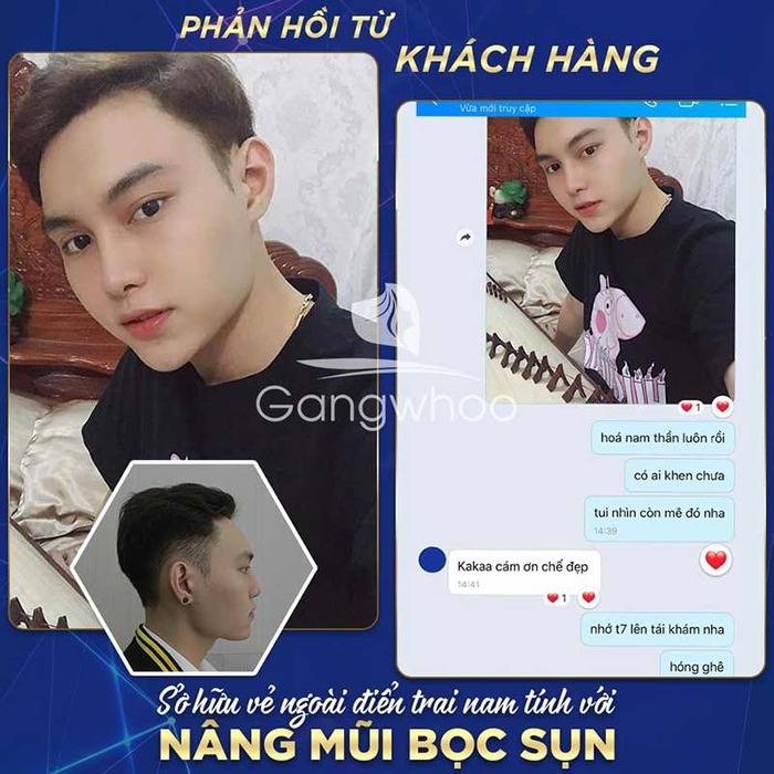 Nâng mũi bọc sụn tự thân phù hợp với nhiều đối tượng