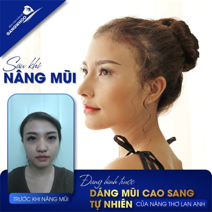 Nâng mũi bọc sụn tự thân khắc phục được những biến chứng sau khi nâng mũi