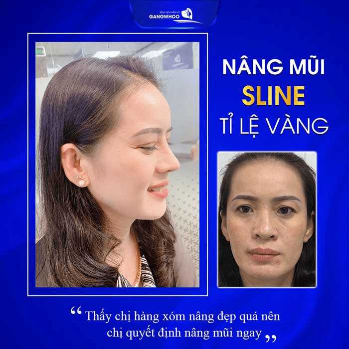 Những trường hợp không được nâng mũi