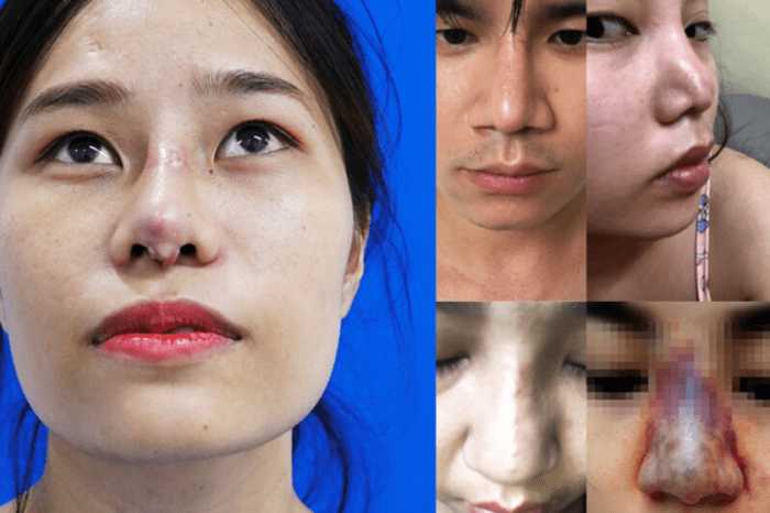 Cách Vệ Sinh Mũi Sau Khi Nâng