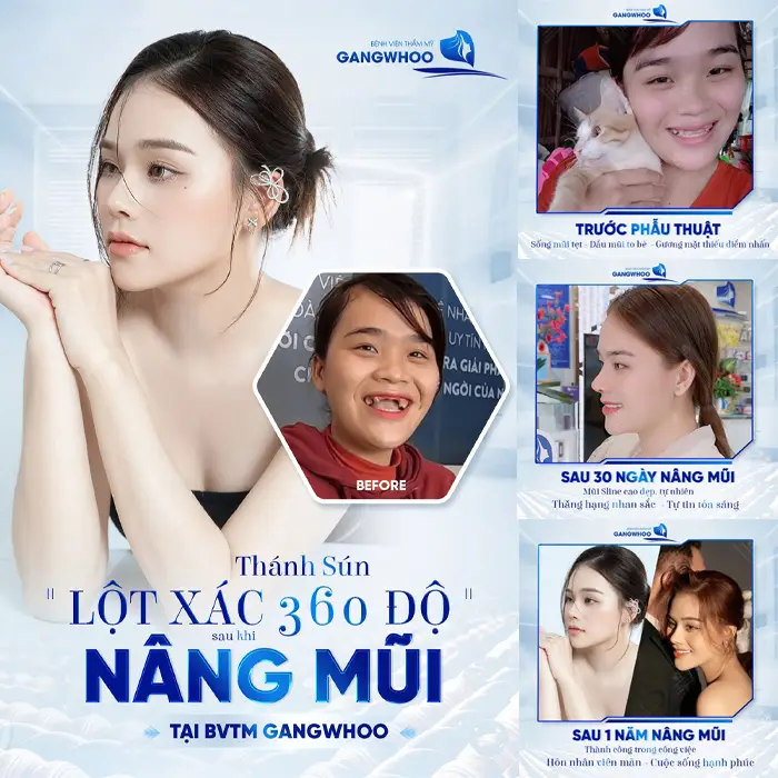 Gợi Ý Top 4 Cơ Sở Nâng Mũi Ở Quận 5 Chất Lượng