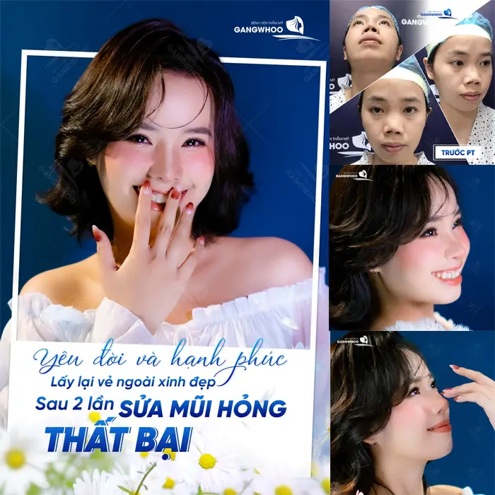 Gợi Ý Top 4 Cơ Sở Nâng Mũi Ở Quận 5 Chất Lượng