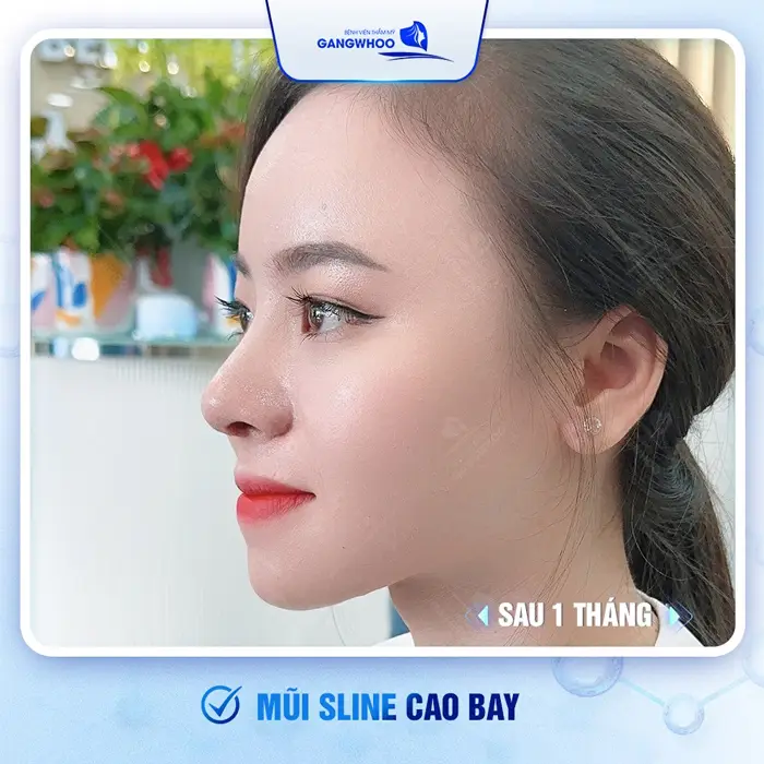 4 Nơi Nâng Mũi Ở Quảng Nam An Tâm Trải Nghiệm Mũi Đẹp Hoàn Mỹ