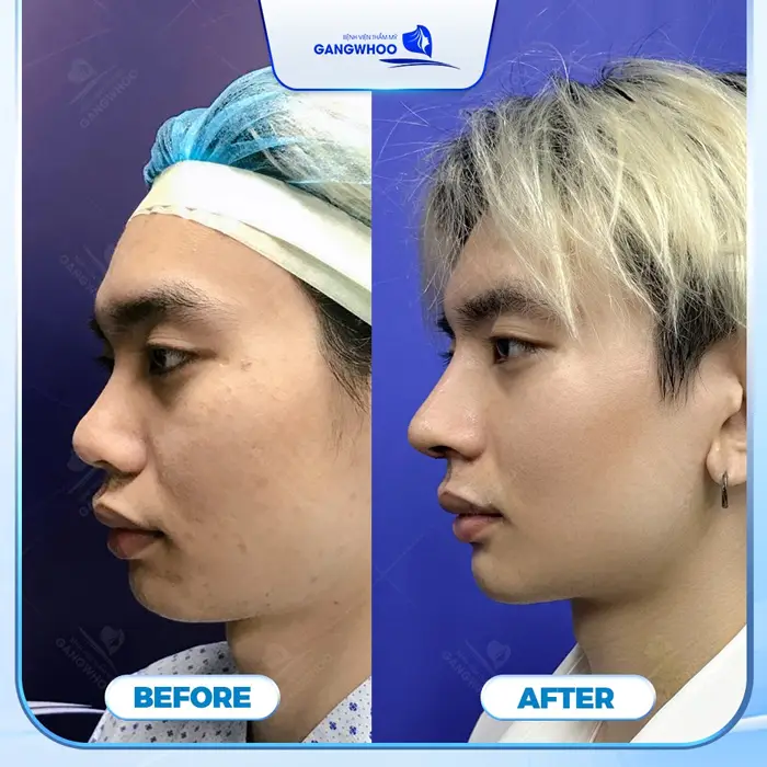 4 Nơi Nâng Mũi Ở Quảng Nam An Tâm Trải Nghiệm Mũi Đẹp Hoàn Mỹ