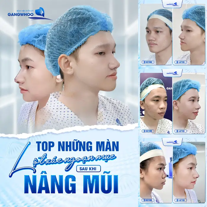 Hé Lộ 3 Cơ Sở Nâng Mũi Ở Vĩnh Long Xịn Xò Không Nên Bỏ Qua