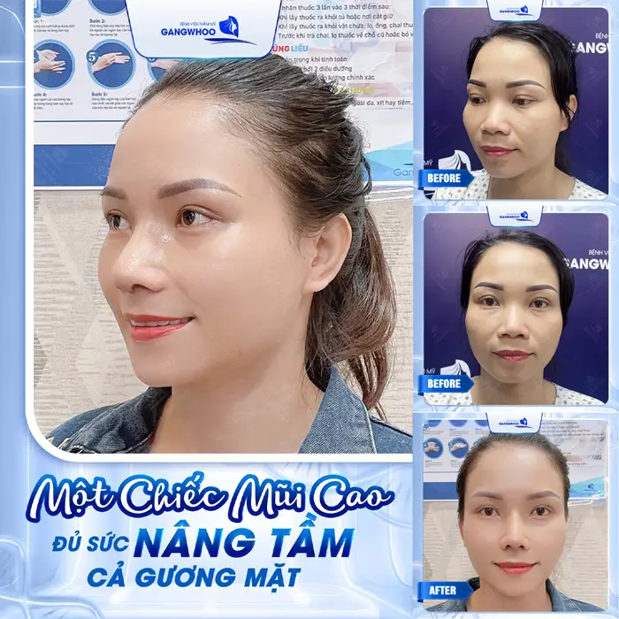 Hé Lộ 3 Cơ Sở Nâng Mũi Ở Vĩnh Long Xịn Xò Không Nên Bỏ Qua