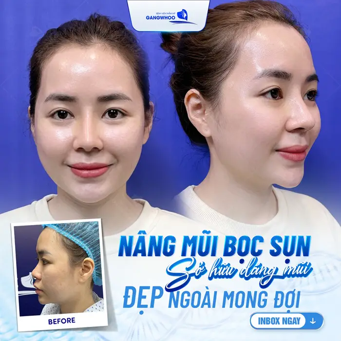 Mũi Đẹp Hoàn Mỹ Nếu Biết Đến 5 Cơ Sở Nâng Mũi Ở Khánh Hòa