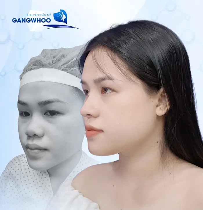 4 Nơi Nâng Mũi Ở Quảng Nam An Tâm Trải Nghiệm Mũi Đẹp Hoàn Mỹ