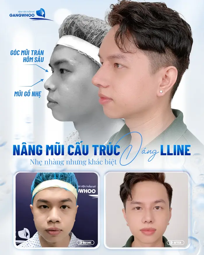 Hé Lộ 3 Cơ Sở Nâng Mũi Ở Vĩnh Long Xịn Xò Không Nên Bỏ Qua