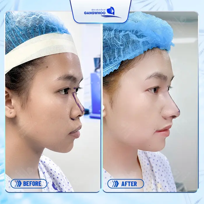 Hé Lộ 3 Cơ Sở Nâng Mũi Ở Vĩnh Long Xịn Xò Không Nên Bỏ Qua