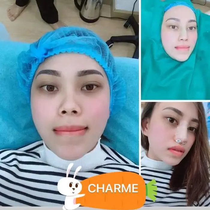 Nâng Mũi Ở Bình Thuận
