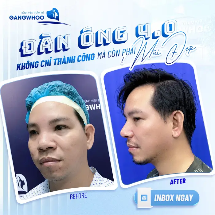Nâng Mũi Ở Đồng Tháp Có Gì Hot? Top Cơ Sở Giúp Bạn “Lên Hương” Ngoại Hình