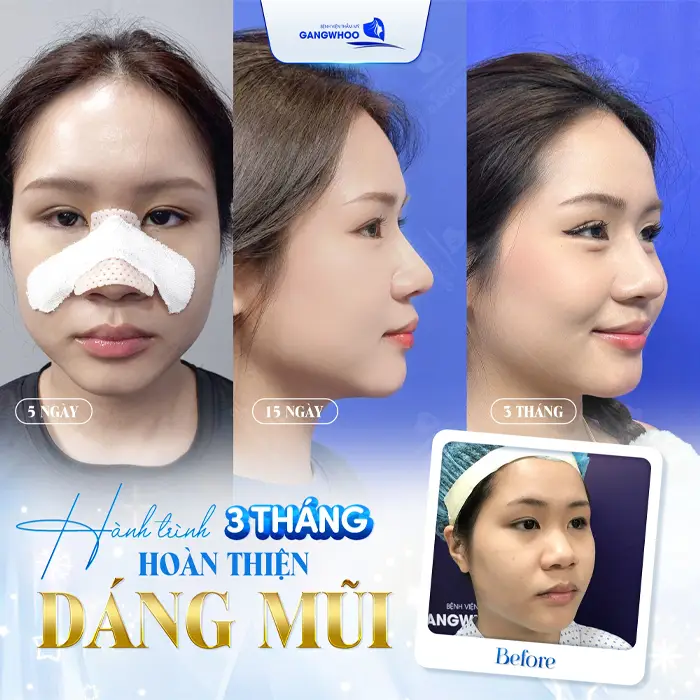 Bật Mí 2 Địa Chỉ Nâng Mũi Ở Nam Định Giúp Bạn “Lột Xác” Ngoạn Mục!