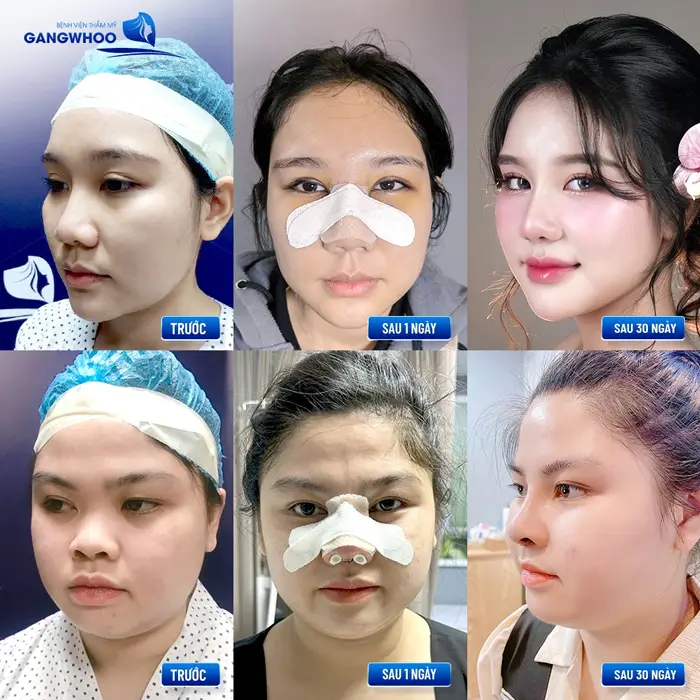 Nâng Mũi Ở Bình Định Đẹp Chuẩn Sao Hàn Hãy Nắm Lòng 5 Địa Chỉ Này