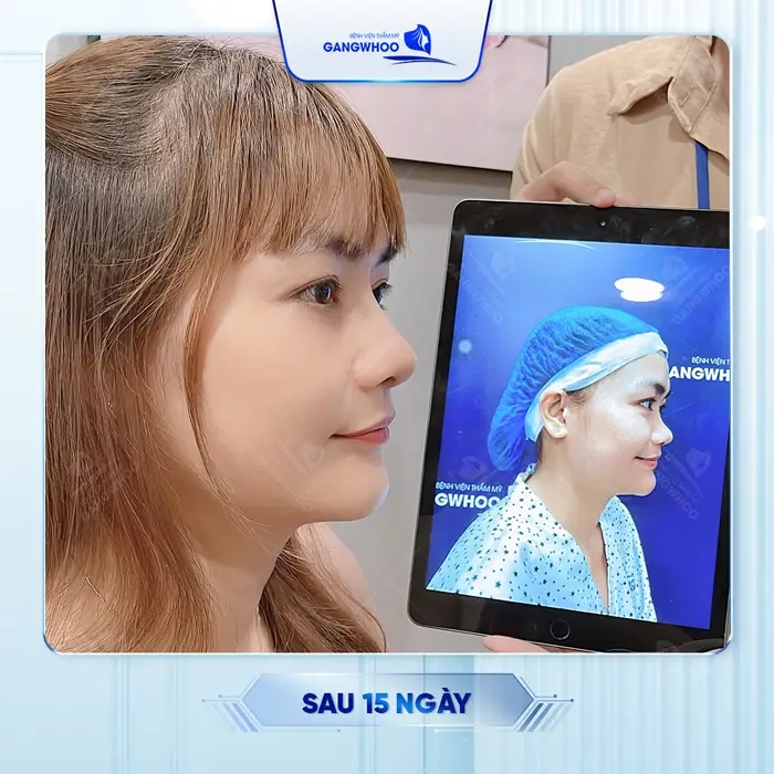 Nâng Mũi Ở Bình Định Đẹp Chuẩn Sao Hàn Hãy Nắm Lòng 5 Địa Chỉ Này