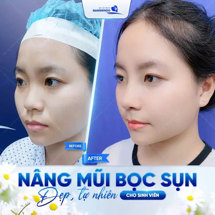 Sức Hút Khó Cưỡng Từ 4 Địa Chỉ Nâng Mũi Ở Bạc Liêu