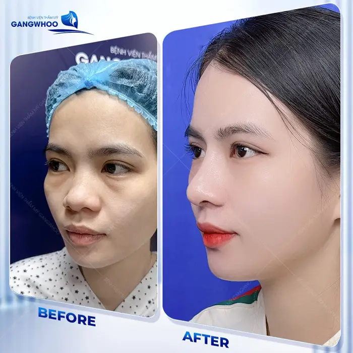 Sức Hút Khó Cưỡng Từ 4 Địa Chỉ Nâng Mũi Ở Bạc Liêu