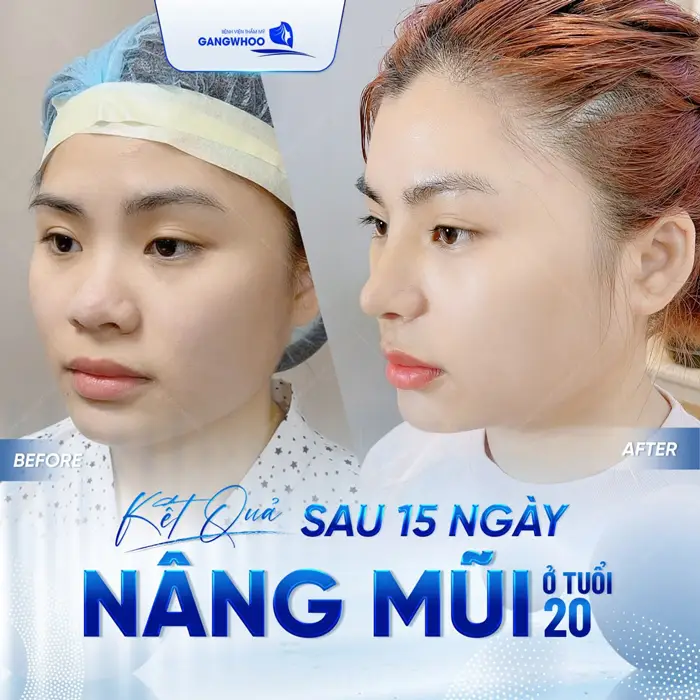 Sức Hút Khó Cưỡng Từ 4 Địa Chỉ Nâng Mũi Ở Bạc Liêu